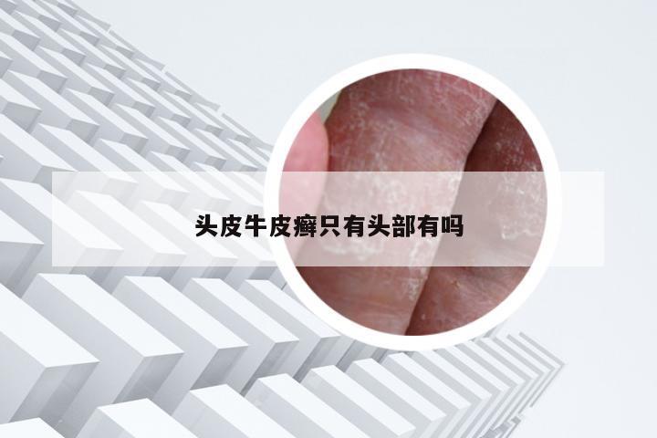 头皮牛皮癣只有头部有吗