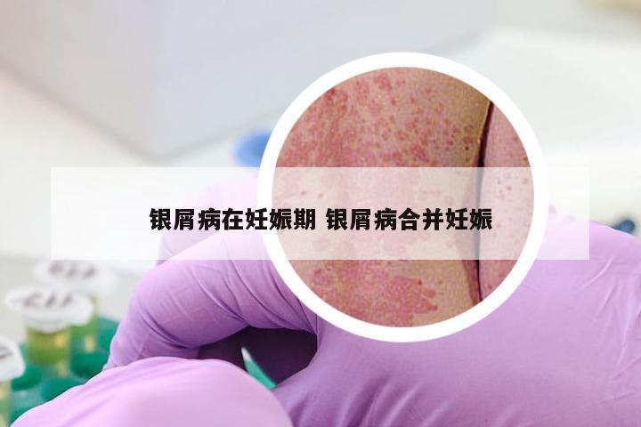 银屑病在妊娠期 银屑病合并妊娠