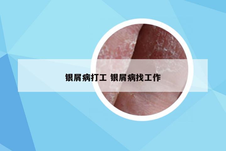 银屑病打工 银屑病找工作