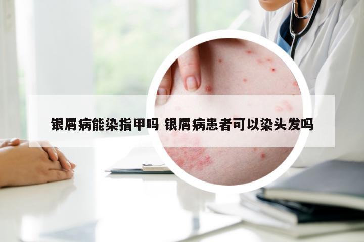 银屑病能染指甲吗 银屑病患者可以染头发吗