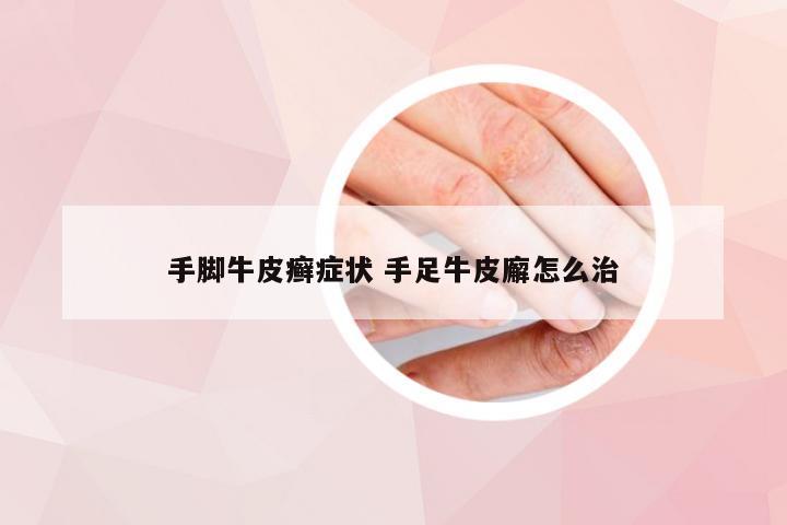 手脚牛皮癣症状 手足牛皮廨怎么治