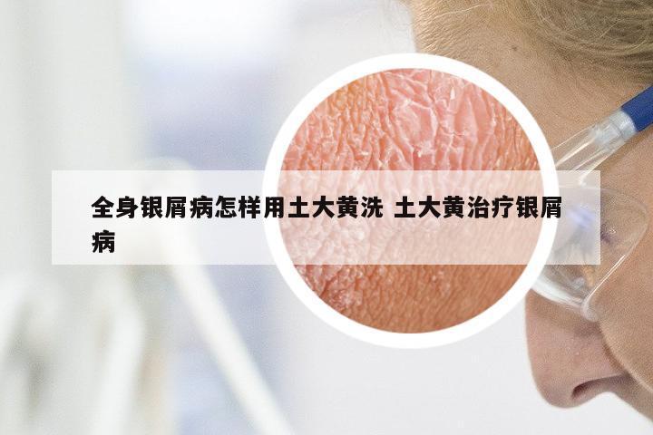 全身银屑病怎样用土大黄洗 土大黄治疗银屑病