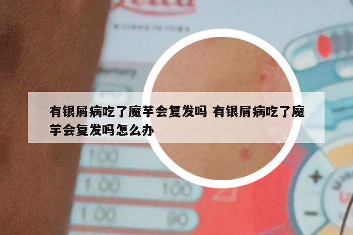 有银屑病吃了魔芋会复发吗 有银屑病吃了魔芋会复发吗怎么办