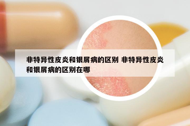 非特异性皮炎和银屑病的区别 非特异性皮炎和银屑病的区别在哪