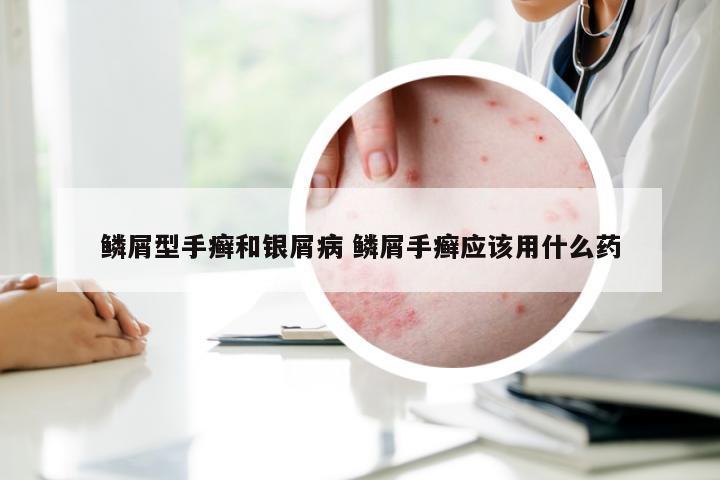 鳞屑型手癣和银屑病 鳞屑手癣应该用什么药