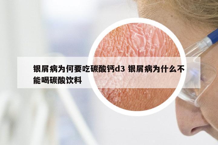 银屑病为何要吃碳酸钙d3 银屑病为什么不能喝碳酸饮料
