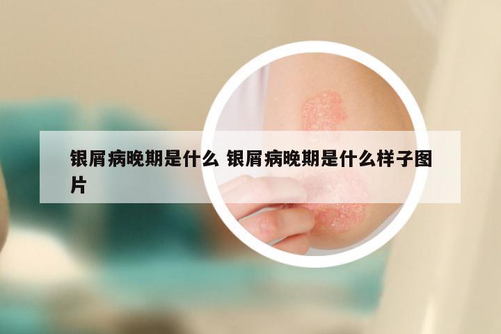 银屑病晚期是什么 银屑病晚期是什么样子图片