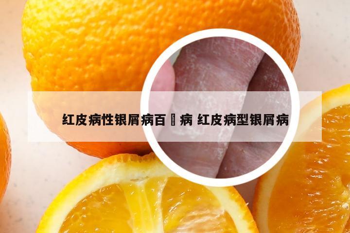 红皮病性银屑病百疕病 红皮病型银屑病
