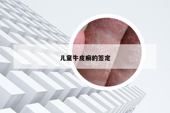 儿童牛皮癣的签定