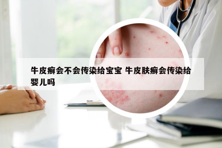 牛皮癣会不会传染给宝宝 牛皮肤癣会传染给婴儿吗