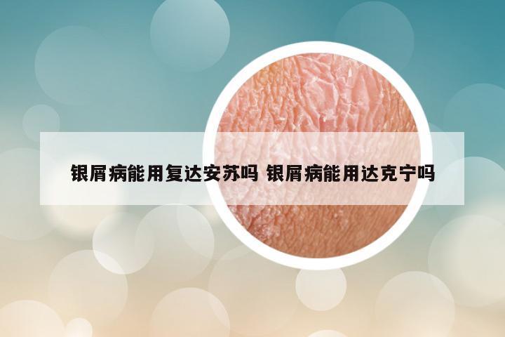 银屑病能用复达安苏吗 银屑病能用达克宁吗