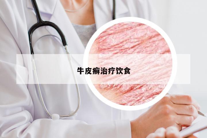 牛皮癣治疗饮食