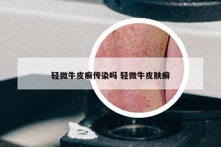 轻微牛皮癣传染吗 轻微牛皮肤癣