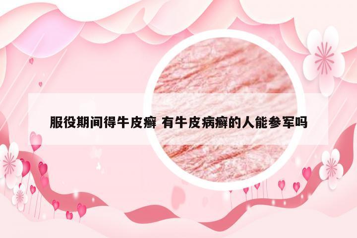 服役期间得牛皮癣 有牛皮病癣的人能参军吗