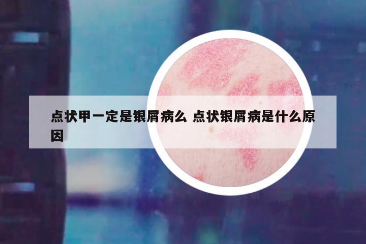 点状甲一定是银屑病么 点状银屑病是什么原因