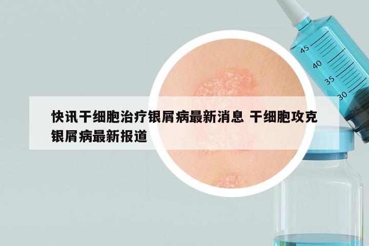 快讯干细胞治疗银屑病最新消息 干细胞攻克银屑病最新报道
