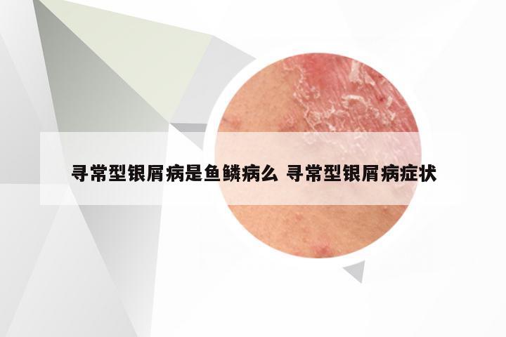 寻常型银屑病是鱼鳞病么 寻常型银屑病症状