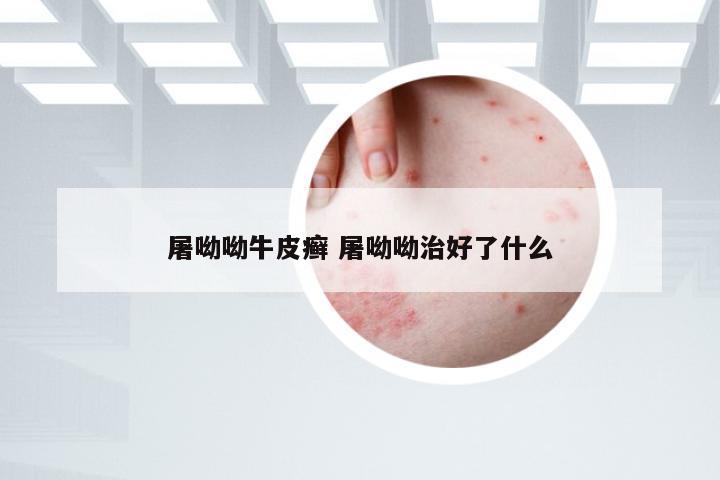 屠呦呦牛皮癣 屠呦呦治好了什么