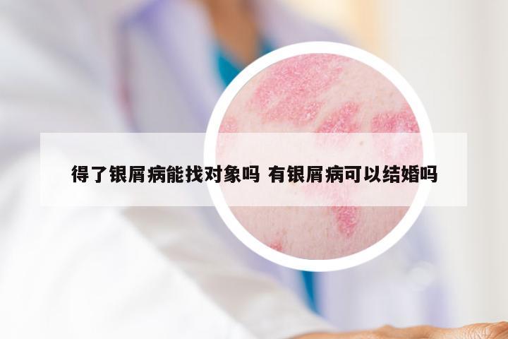 得了银屑病能找对象吗 有银屑病可以结婚吗