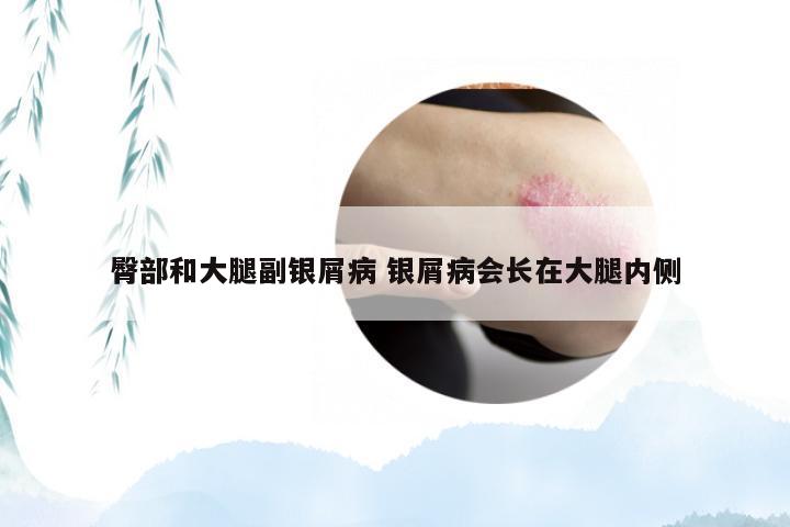 臀部和大腿副银屑病 银屑病会长在大腿内侧