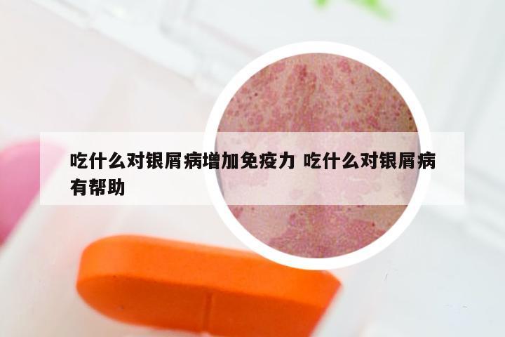 吃什么对银屑病增加免疫力 吃什么对银屑病有帮助