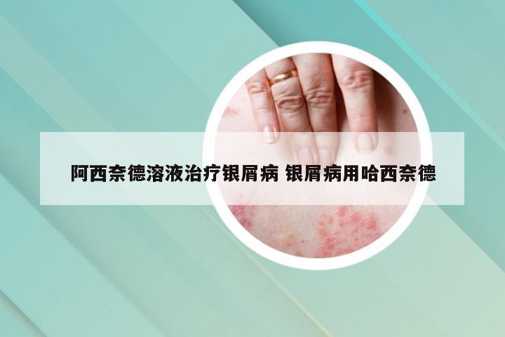 阿西奈德溶液治疗银屑病 银屑病用哈西奈德