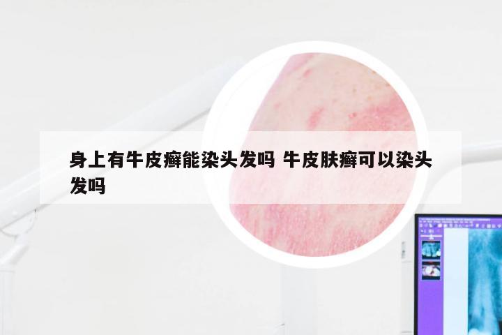 身上有牛皮癣能染头发吗 牛皮肤癣可以染头发吗