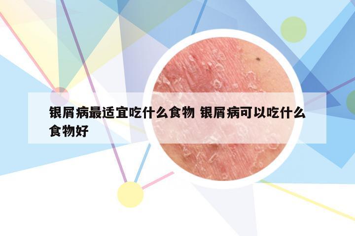 银屑病最适宜吃什么食物 银屑病可以吃什么食物好