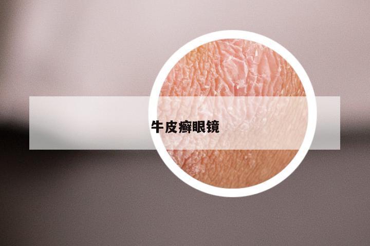 牛皮癣眼镜