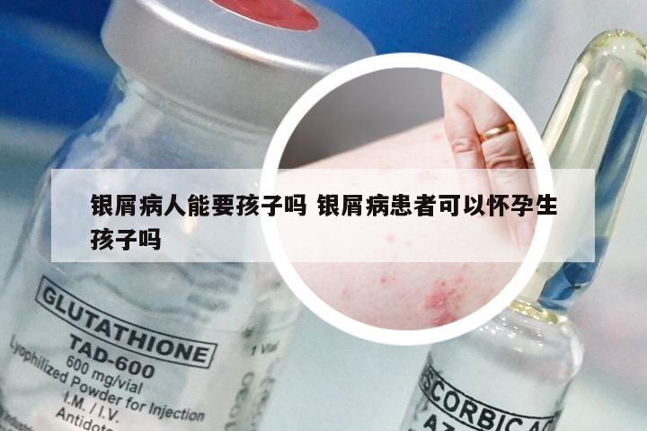 银屑病人能要孩子吗 银屑病患者可以怀孕生孩子吗