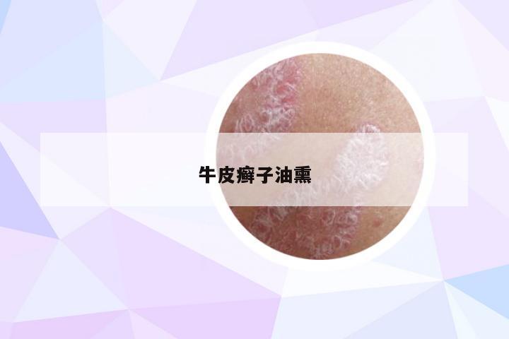 牛皮癣子油熏