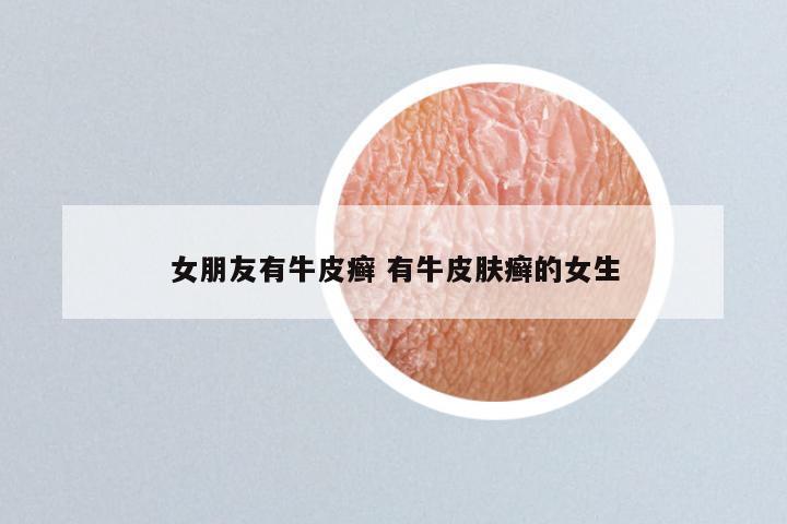 女朋友有牛皮癣 有牛皮肤癣的女生