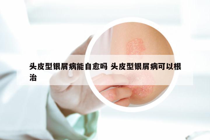 头皮型银屑病能自愈吗 头皮型银屑病可以根治