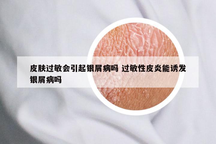 皮肤过敏会引起银屑病吗 过敏性皮炎能诱发银屑病吗