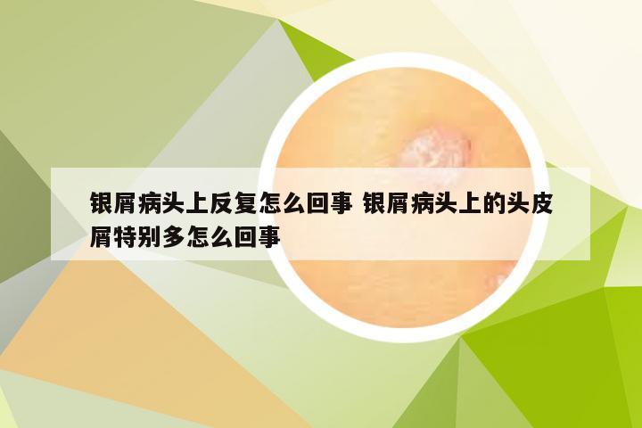 银屑病头上反复怎么回事 银屑病头上的头皮屑特别多怎么回事