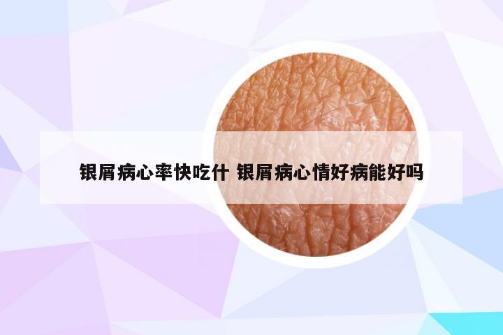 银屑病心率快吃什 银屑病心情好病能好吗