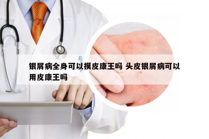 银屑病全身可以摸皮康王吗 头皮银屑病可以用皮康王吗