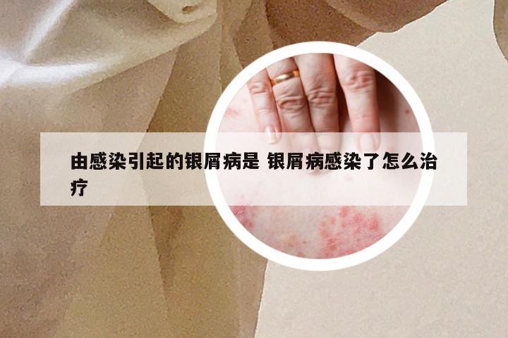 由感染引起的银屑病是 银屑病感染了怎么治疗