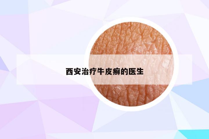 西安治疗牛皮癣的医生
