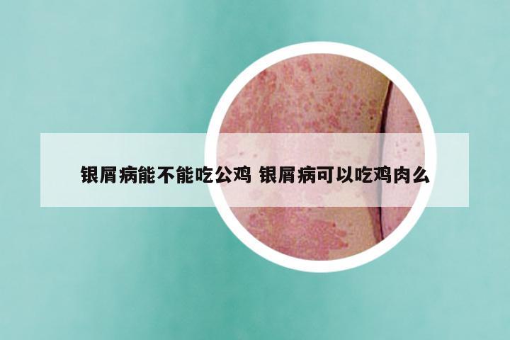 银屑病能不能吃公鸡 银屑病可以吃鸡肉么