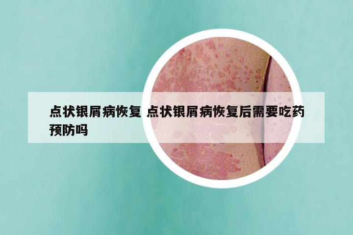 点状银屑病恢复 点状银屑病恢复后需要吃药预防吗