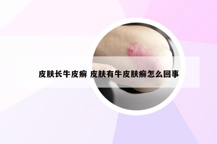皮肤长牛皮癣 皮肤有牛皮肤癣怎么回事