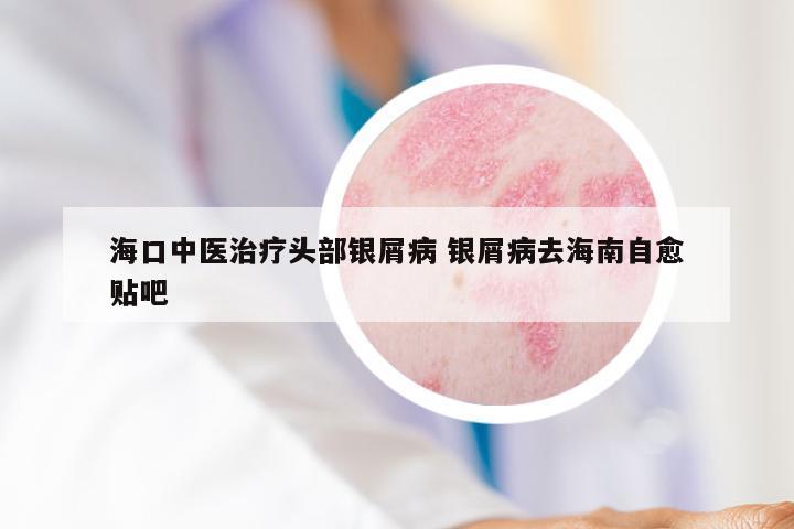 海口中医治疗头部银屑病 银屑病去海南自愈贴吧
