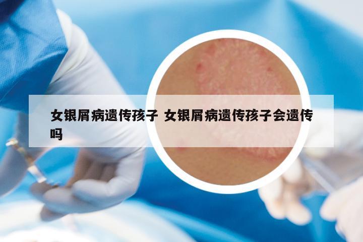 女银屑病遗传孩子 女银屑病遗传孩子会遗传吗