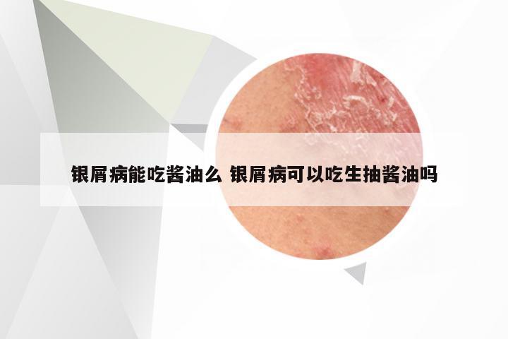 银屑病能吃酱油么 银屑病可以吃生抽酱油吗
