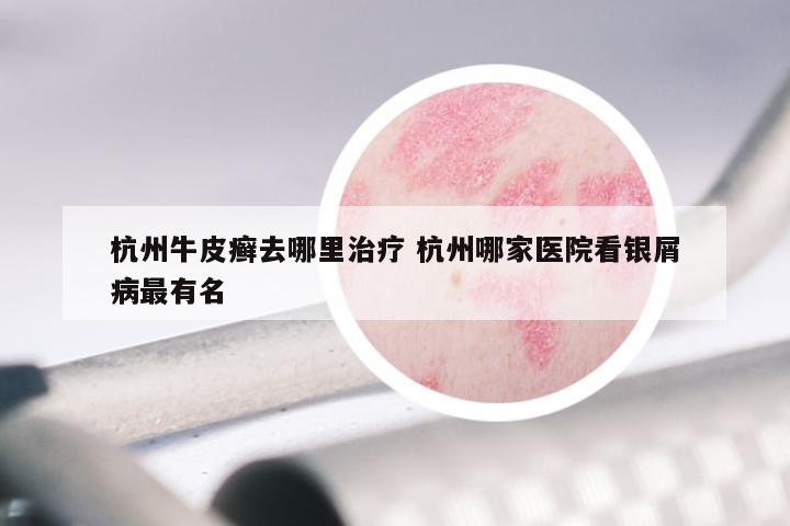 杭州牛皮癣去哪里治疗 杭州哪家医院看银屑病最有名