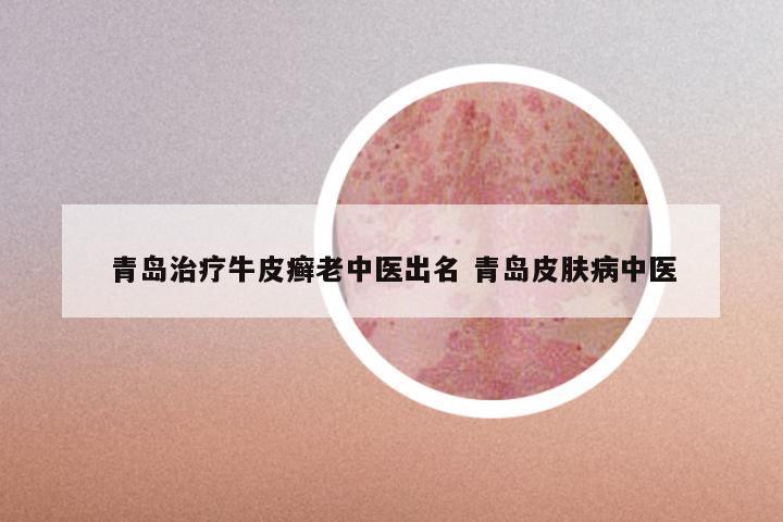 青岛治疗牛皮癣老中医出名 青岛皮肤病中医