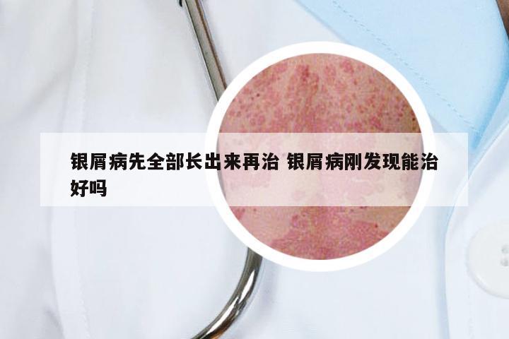 银屑病先全部长出来再治 银屑病刚发现能治好吗