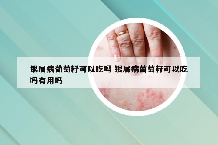 银屑病葡萄籽可以吃吗 银屑病葡萄籽可以吃吗有用吗