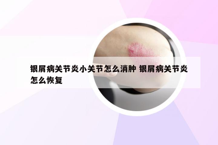 银屑病关节炎小关节怎么消肿 银屑病关节炎怎么恢复